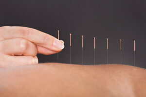 about-acupuncture- istockphoto_38800846