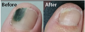 Laser therapy relieves nagging toe problem