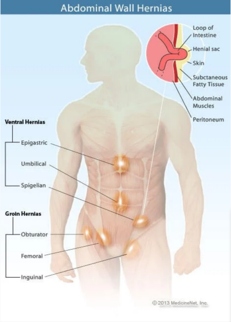 Graphic courtesy of MedicineNet. (https://www.medicinenet.com/hernia_overview/article.htm)