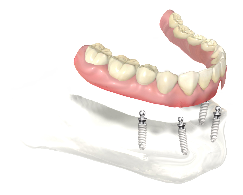 Complete bottom teeth that secure to multiple implants