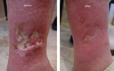 Joyce Vein Before & After of Venous Leg Ulcer