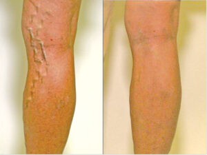 Before & After of Venous Disease