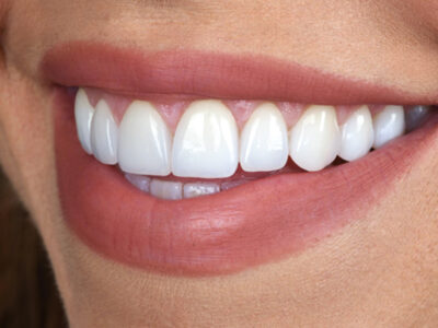 Want A Simple Smile Makeover?