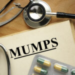 Mumps across the US and how to prevent it and spot it