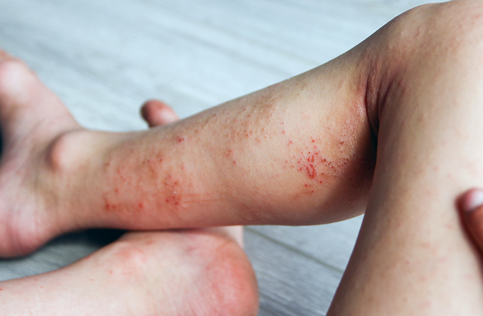 Scaly, Itchy Legs? Is it Stasis Dermatitis?