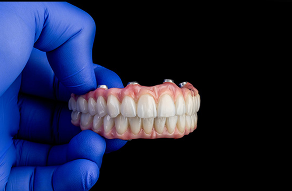 Replacing Partials With Dental Implants