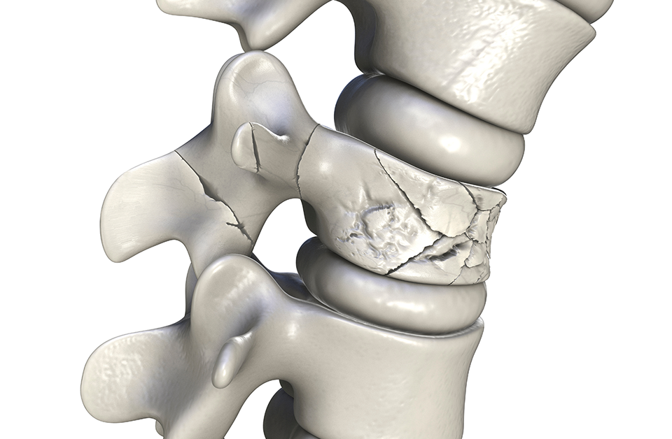 Kyphoplasty Relieves Spinal Fracture Pain