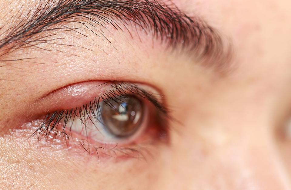 Taking Extra Steps To Rule Out Eyelid Cancer