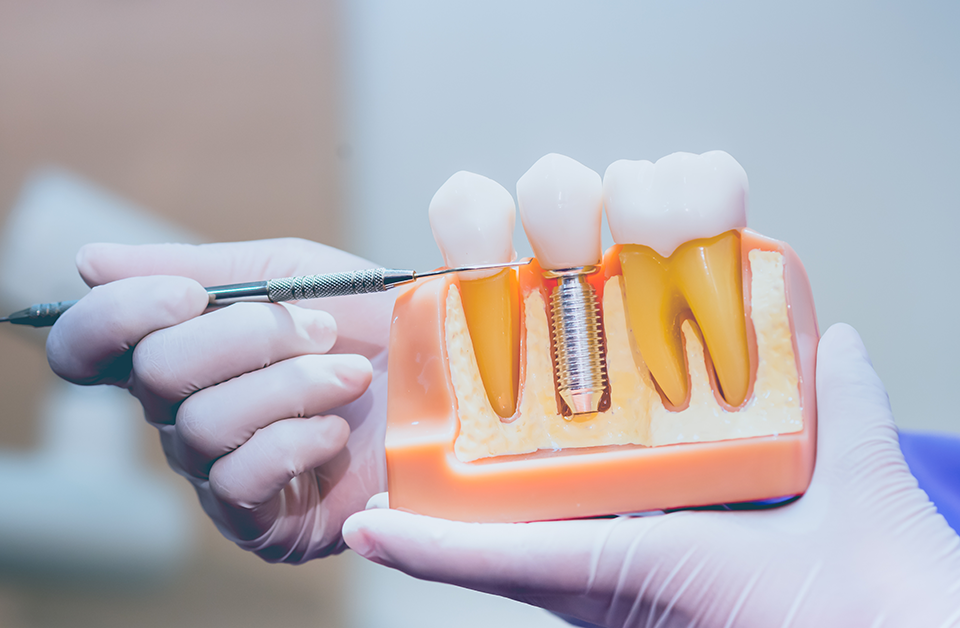 Dental Implants Keep Lower Denture Secured
