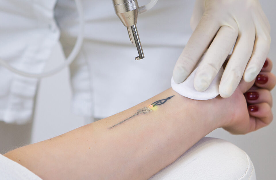 PicoSure Pro Laser: The Gold Standard in Tattoo Removal and Skin Rejuvenation