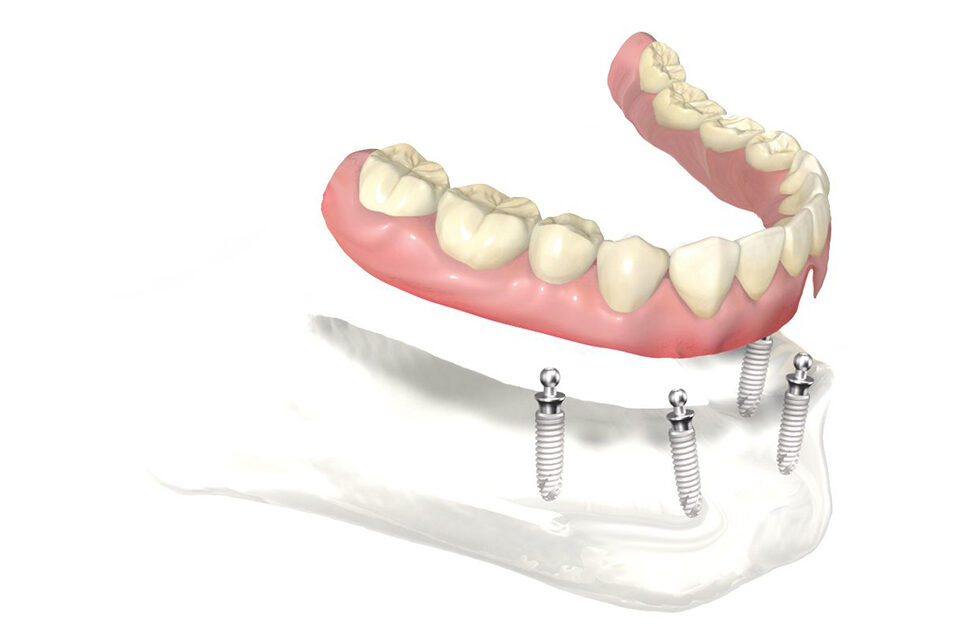 Advanced Dental Solutions: Implant-Secured Dentures for Improved Stability